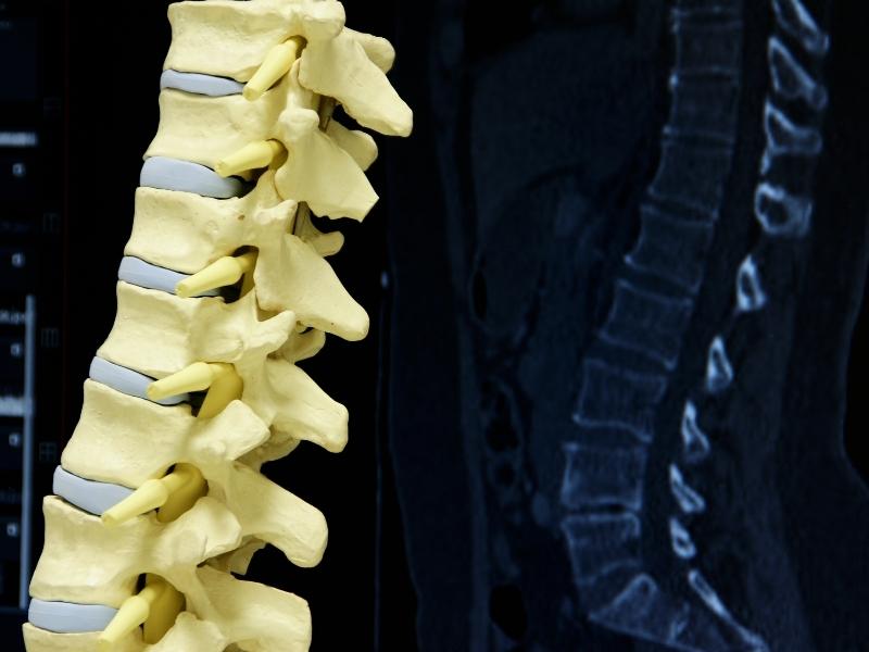 Cirurgia da Coluna